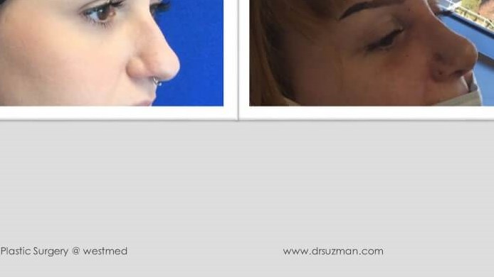 Dr. Suzman Rhinoplasty